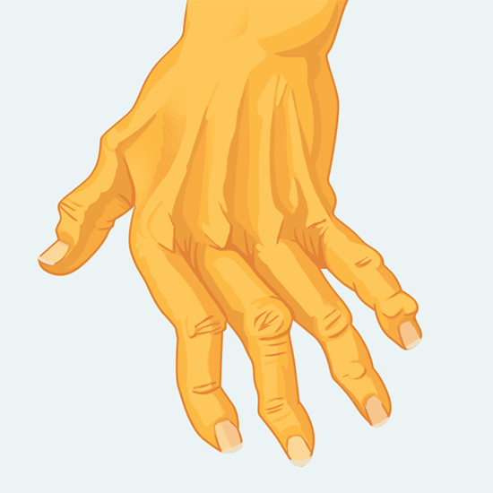 rheumatoid arthritis panel test